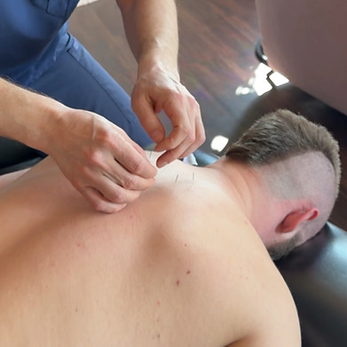 accupuncture1.jpeg