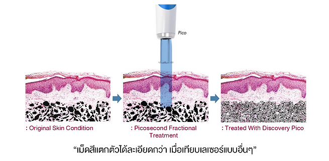 Treated With Discovery Pico.png
