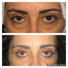 Tudo que você precisa saber sobre a Blefaroplastia