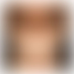 Tudo que você precisa saber sobre a Blefaroplastia
