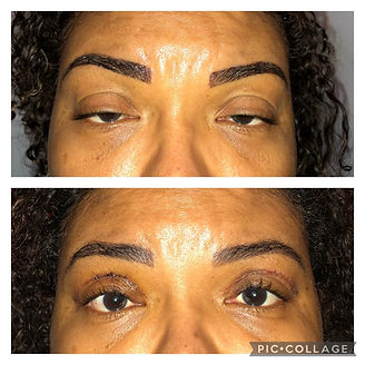 Ptose Palpebral Antes e depois | Dra. Camila Cheble - RJ