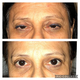 Ptose Palpebral Antes e depois | Dra. Camila Cheble - RJ