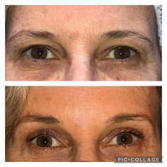 Blefaroplastia com Simetização do Supercílio: O Que Você Precisa Saber