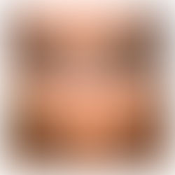 Blefaroplastia com Simetização do Supercílio: O Que Você Precisa Saber