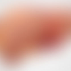 Tratamiento Natural y alopatico Para problemas hepáticos