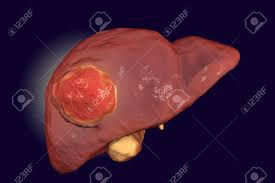 ¿POR QUE SE ORIGINA EL CÁNCER?