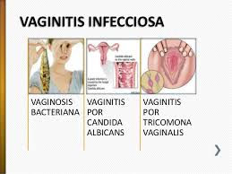 ¿Que es una Infección Vaginal o Vaginitis ?