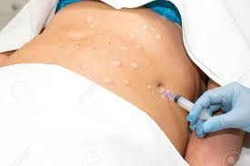 ¿¿Sirve la mesoterapia para bajar de peso??