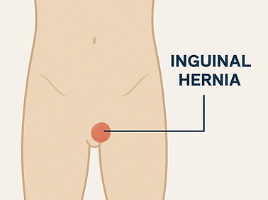 inguinal.png