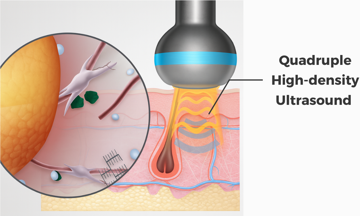 Advanced LDM ultrasound and plasma technology used to improve skin texture, glow, and firm