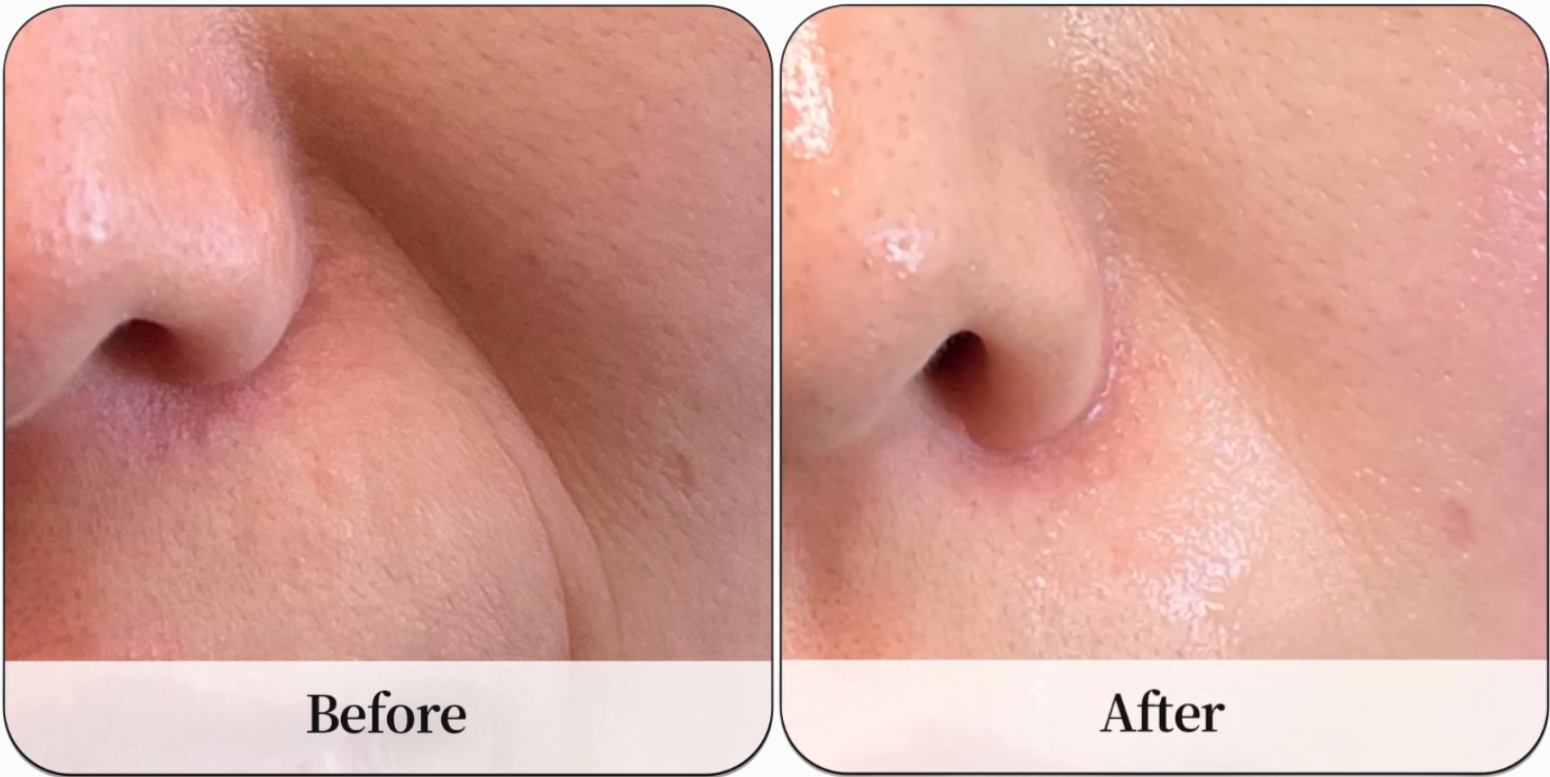Before and After Special facial skincare treatment at PUREGLAM Beauty using advanced LDM u