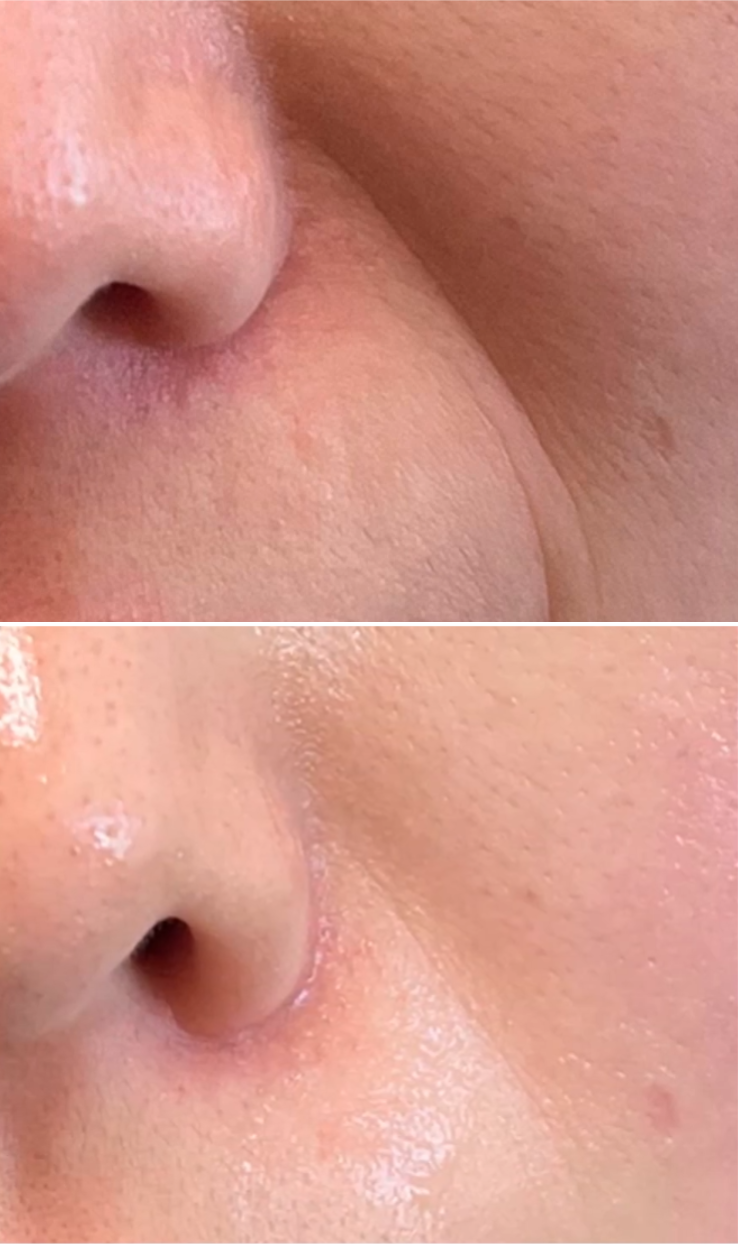 Special facial skincare treatment at PUREGLAM Beauty using advanced LDM ultrasound and plasma technology to rejuvenate the sk