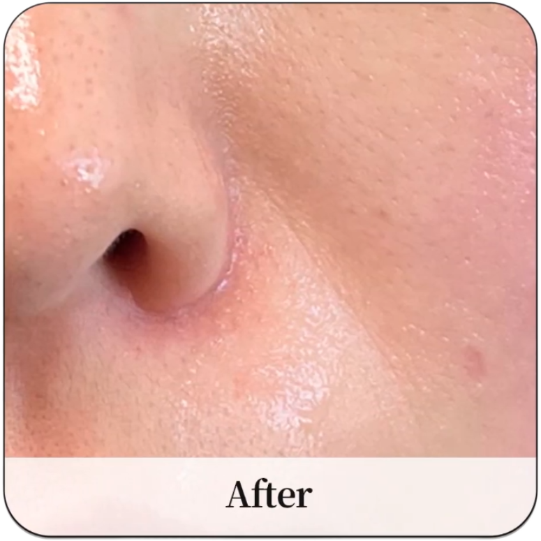 close look After LDM treatment at PUREGLAM Beauty in Melbourne CBD