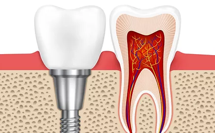 Dental impalnts near me in greater noida