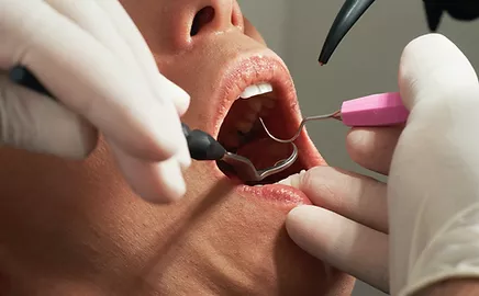 Root Canal treatment in greater noida