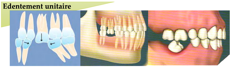 Schéma des solutions face à l’édentement : implant, prothèse, bridge