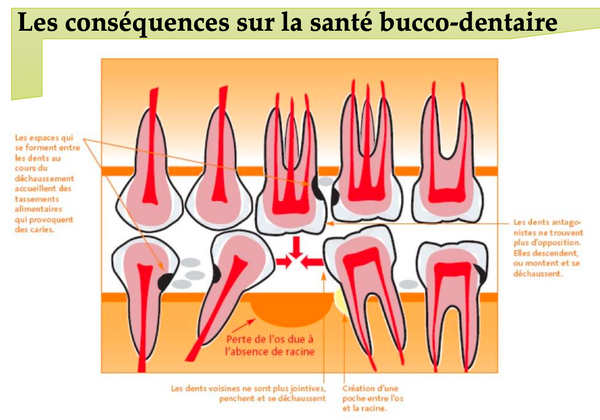 Plan de traitement proposé pour édentement total – implants et prothèse