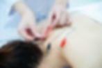 Electroacupuncture Therapy.jpg