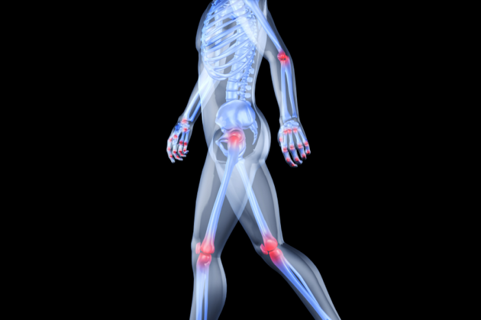 Arthritis