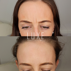 botoxbeforeandafter