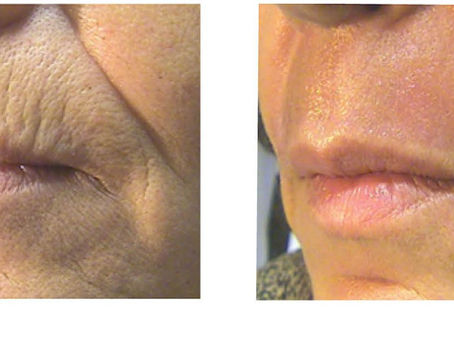 A woman a few months after her Co2 Laser Treatment at Laser & Skin Belfast