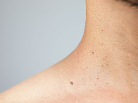 mole mapping at Laser & Skin Belfast