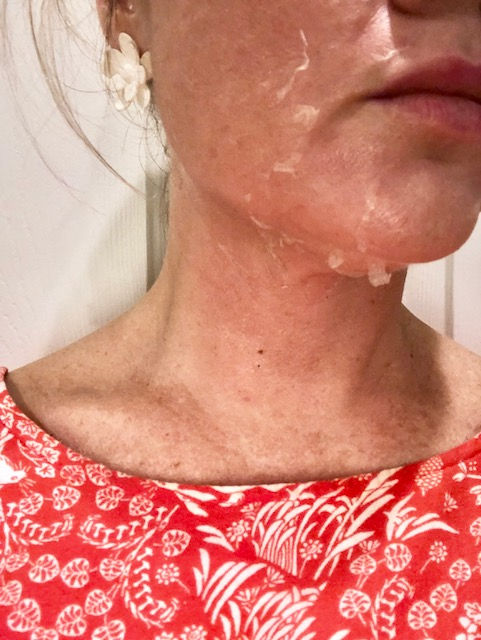 Melasma Progress