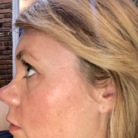 Skincare Results: Sun-spots, Melasma and Peels