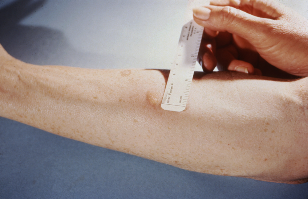 Como é feito o exame da tuberculose e resultados Como é feito o exame da tuberculose e resultados