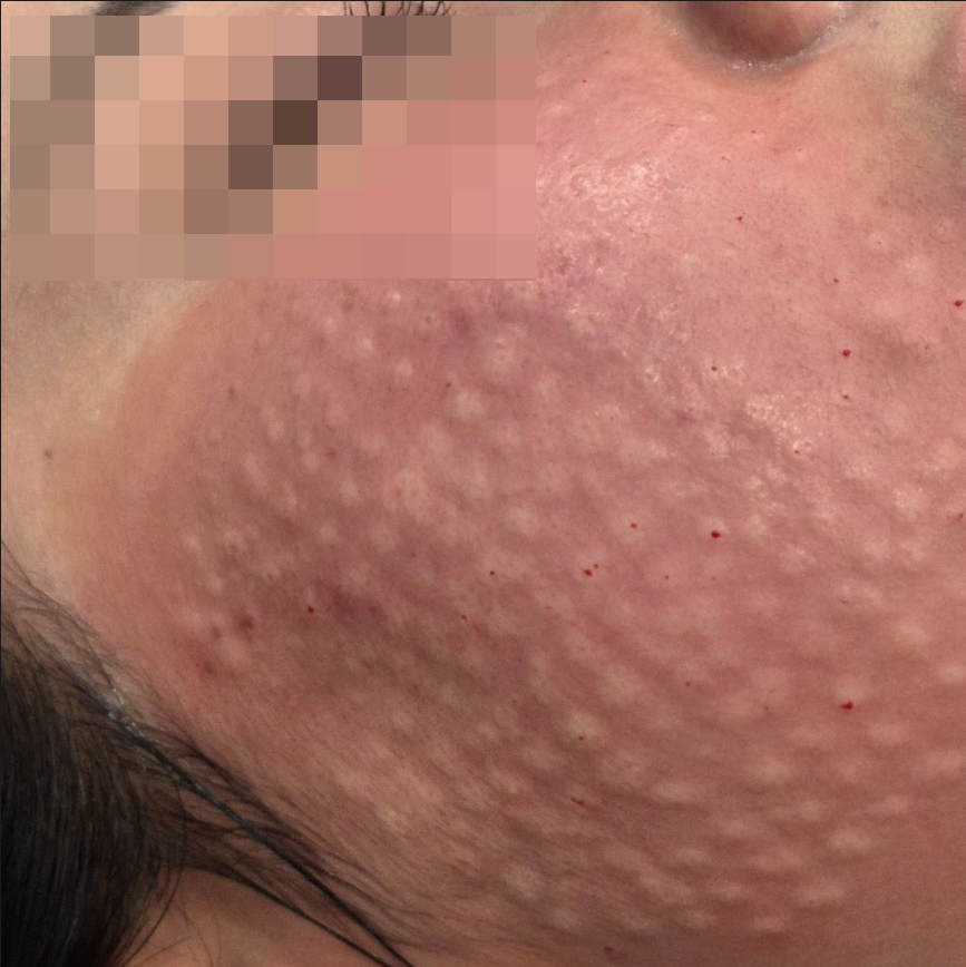Patient right after receiving Rejuran skin booster using Machine injection with micro needles. The bumps are uniform across big surface on the cheeks.