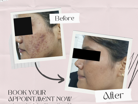 Breaking the Breakout Cycle: Expert Acne Treatments at SkinDerms