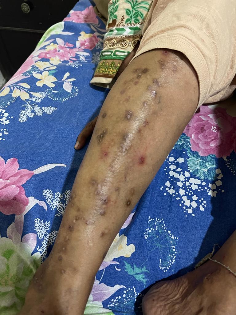 Figure 1. Cutaneous manifestations of porphyria cutanea tarda on the anterior left leg. The image shows the left lower limb with multiple hyperpigmented macules, atrophic scars, and crusted erosions along the shin. Notable features include excoriated papules, healed ulcerations, and extensive post-inflammatory hyperpigmentation. Characteristic findings are the darkly pigmented, shallow depressions indicating healed bullae, perifollicular hyperpigmentation, and scattered erosions on a background of atrophic skin, consistent with the profound photosensitivity and skin fragility of PCT.