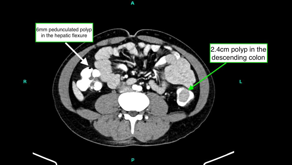 Figure 1. Contrast-enhanced axial CT abdomen demonstrating a large 2.4cm polyp in the descending colon (green arrow) and a 6mm pedunculated polyp in the hepatic flexure (white arrow).