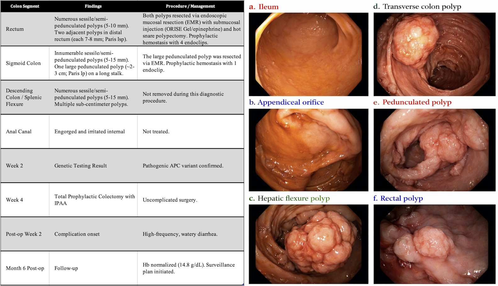 Figure 2. Endoscopic findings on diagnostic colonoscopy demonstrating diffuse colonic polyposis
(a) Terminal ileum with normal-appearing mucosa, intubated briefly for confirmation of cecal landmarks.
(b) Cecum showing the appendiceal orifice with surrounding mucosa; no focal lesion identified at this site.
(c) Hepatic flexure demonstrating a lobulated sessile polyp consistent with adenomatous morphology.
(d) Transverse colon showing a large lobulated polyp with a broad base protruding into the lumen.
(e) Sigmoid colon demonstrating a pedunculated polyp measuring approximately 2–3 cm with a long stalk and smaller attached polyps, consistent with Paris classification Ip (NICE type II); this lesion was resected endoscopically with a hot snare following submucosal injection and prophylactic clip placement.
(f) Rectum showing a sessile to semi-pedunculated polyp (approximately 7–8 mm), corresponding to Paris classification Isp (NICE type II); representative of the numerous small polyps observed in the distal colon.