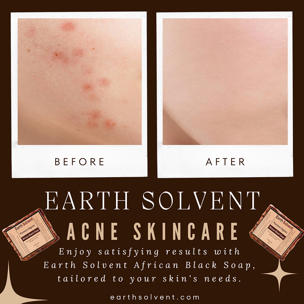 Thumbnail: Before & After Acne Treatment: Earth Solvent African Black Soap for clear skin
