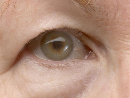 Blepharoplasty