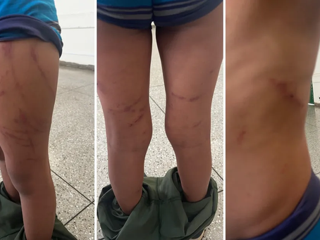 Criança é espancada pela mãe e pelo padrasto até ficar com vários ferimentos pelo corpo