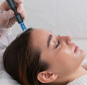 Microneedling_for_Hair_lost_edited_edited.jpg