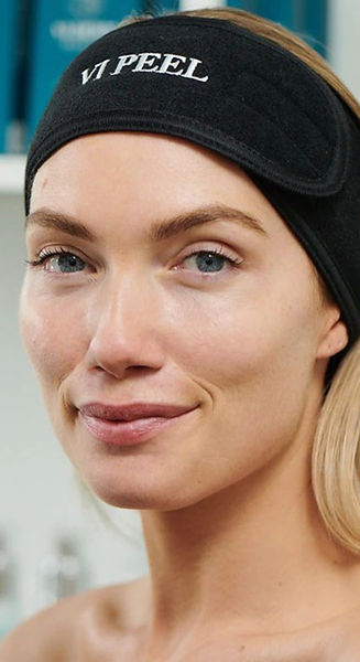 VI Chemical Peel