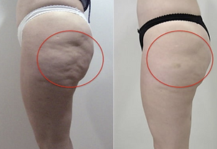 buttocks thighs.PNG