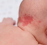 birth mark.jpg