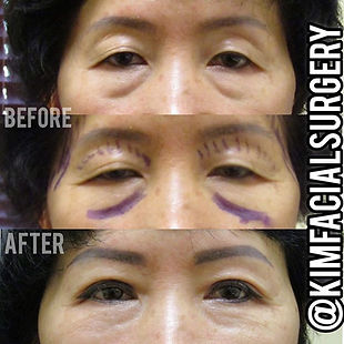 kim facial autologous and bleph.jpg