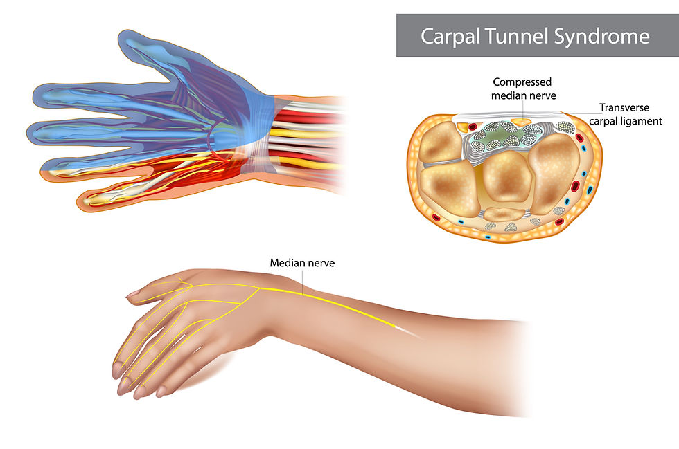 Carpal Tunnel Syndrome