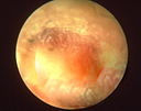 A Middle Ear Infection (Otitis Media)