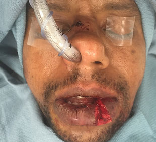 Araya - Lip Laceration (1).jpg