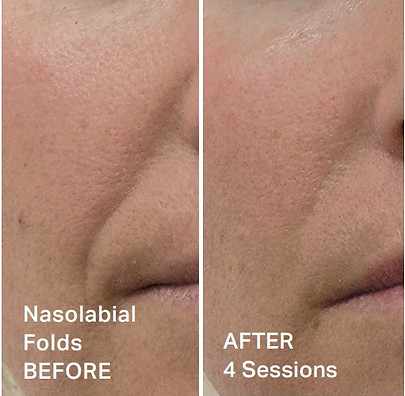 Hydrafacial Before & After