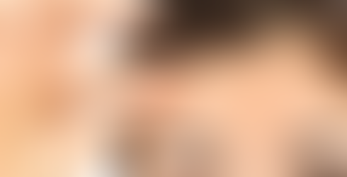 V-Shaped forehead lines. Wrinkle relaxing treatments south wales.