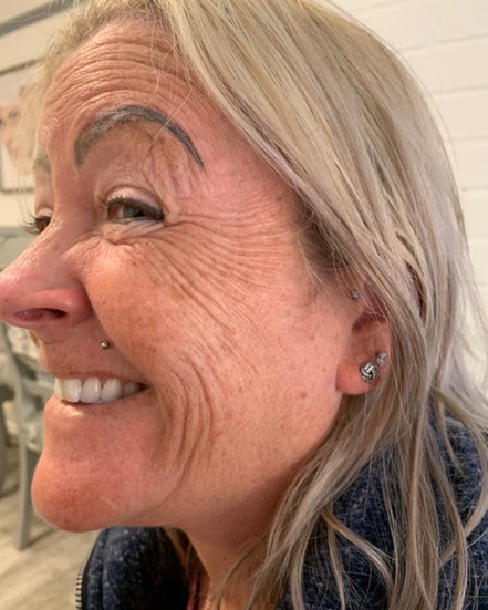 Serenbo Aesthetics Wrinkle Relaxing, Botox, Before and After February 2024. Image of client before wrinkle relaxing treatment at CV Makup Studio Cardiff Bay. Side angle showing forehead and crows feet wrinkles before botulinum toxin treatment. Wrinkle relaxing treatment South Wales.