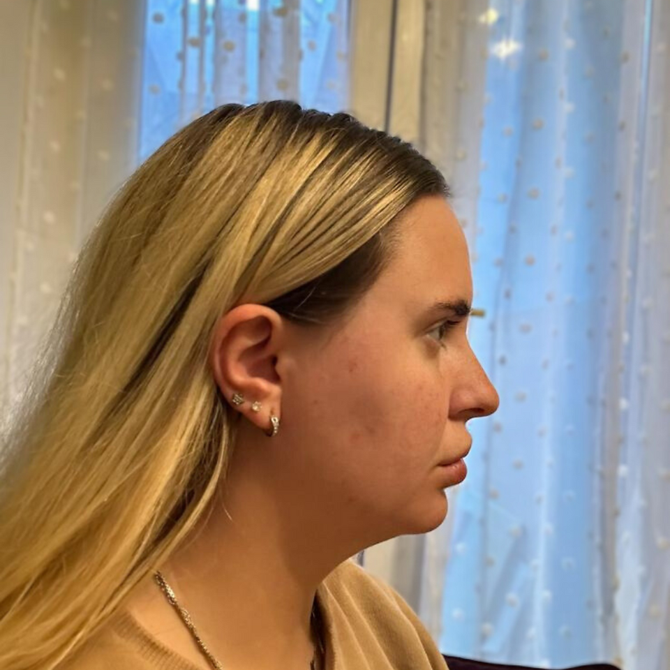 client side profile before dermal filler treatment in porthcawl. flat straight nose profile is clear.