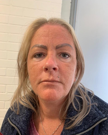 Serenbo Aesthetics Wrinkle Relaxing, Botox, Before and After February 2024. Image of client before wrinkle relaxing treatment at CV Makup Studio Cardiff Bay. Front angle showing forehead wrinkles before botulinum toxin treatment.